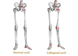 normal and low arch stress points